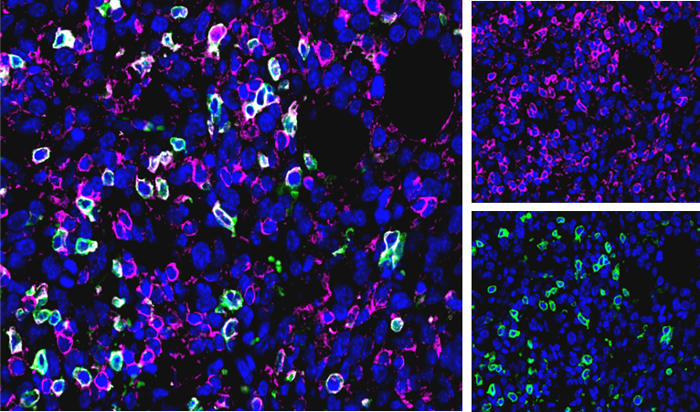 图1:CT26肿瘤中CD3(粉红色)、CD4(绿色)、DAPI(蓝色)染色。