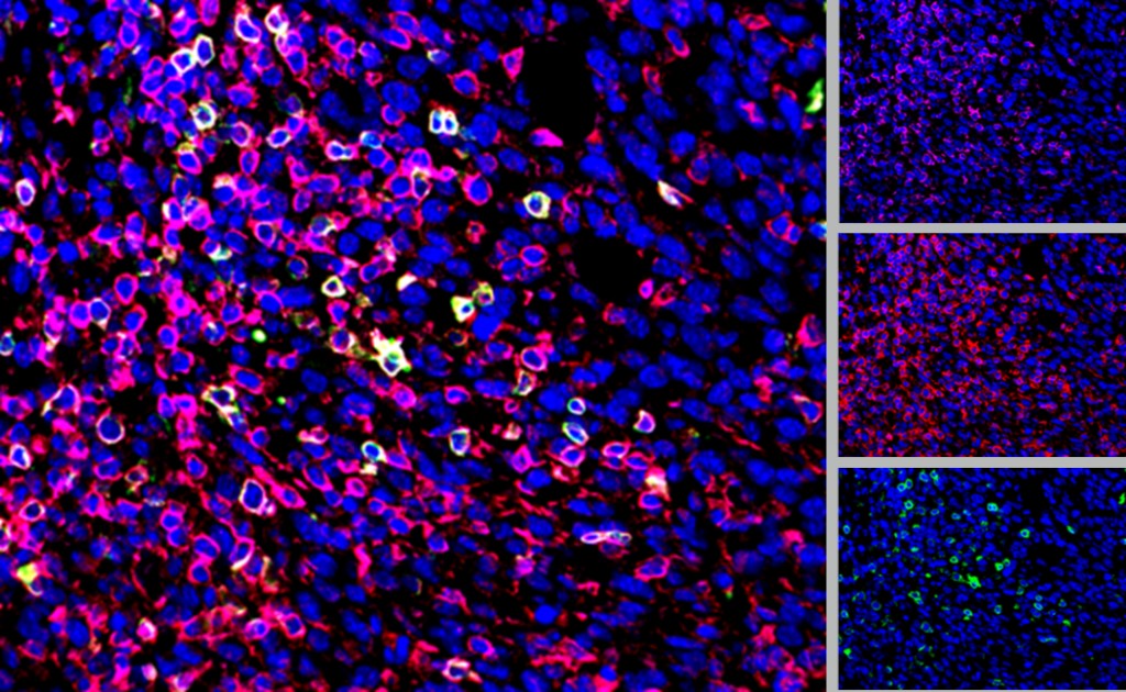 图2：CD3（粉红色），CD4（绿色），CD45（红）和DAPI（蓝色）染色在CT26肿瘤。