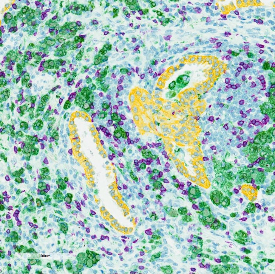 Human NSCLC Adeno CD3CD68CK Triple Stain